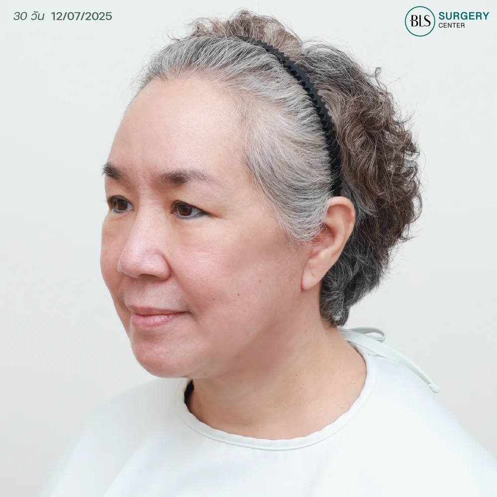 ดึงหน้าอยู่ได้กี่ปี (รีวิวแม่เขื่อน ภัทรดนัย)