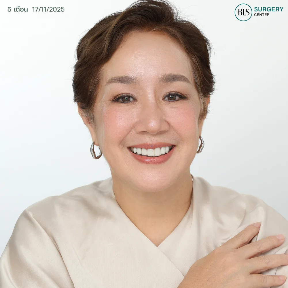 แม่เขื่อน ภัทรดนัย แก้ไขหน้าหย่อนคล้อย คอหย่อน ที่ BLS Surgery Center