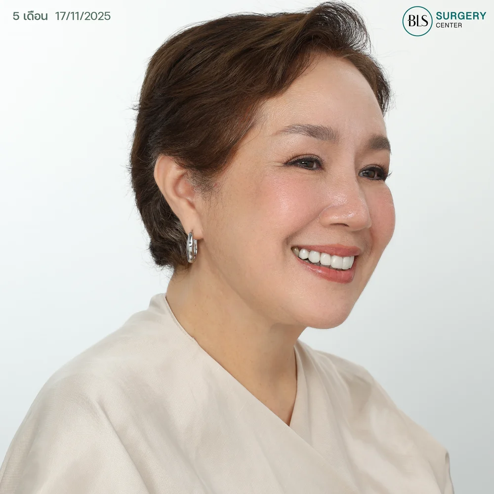 แม่เขื่อน ภัทรดนัย แก้ไขหน้าหย่อนคล้อย คอหย่อน ที่ BLS Surgery Center