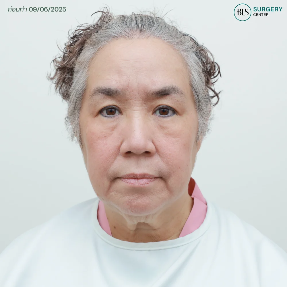 ศัลยกรรมดึงคอ ช่วยอะไร แม่ตั้มพร้อมเฉลย