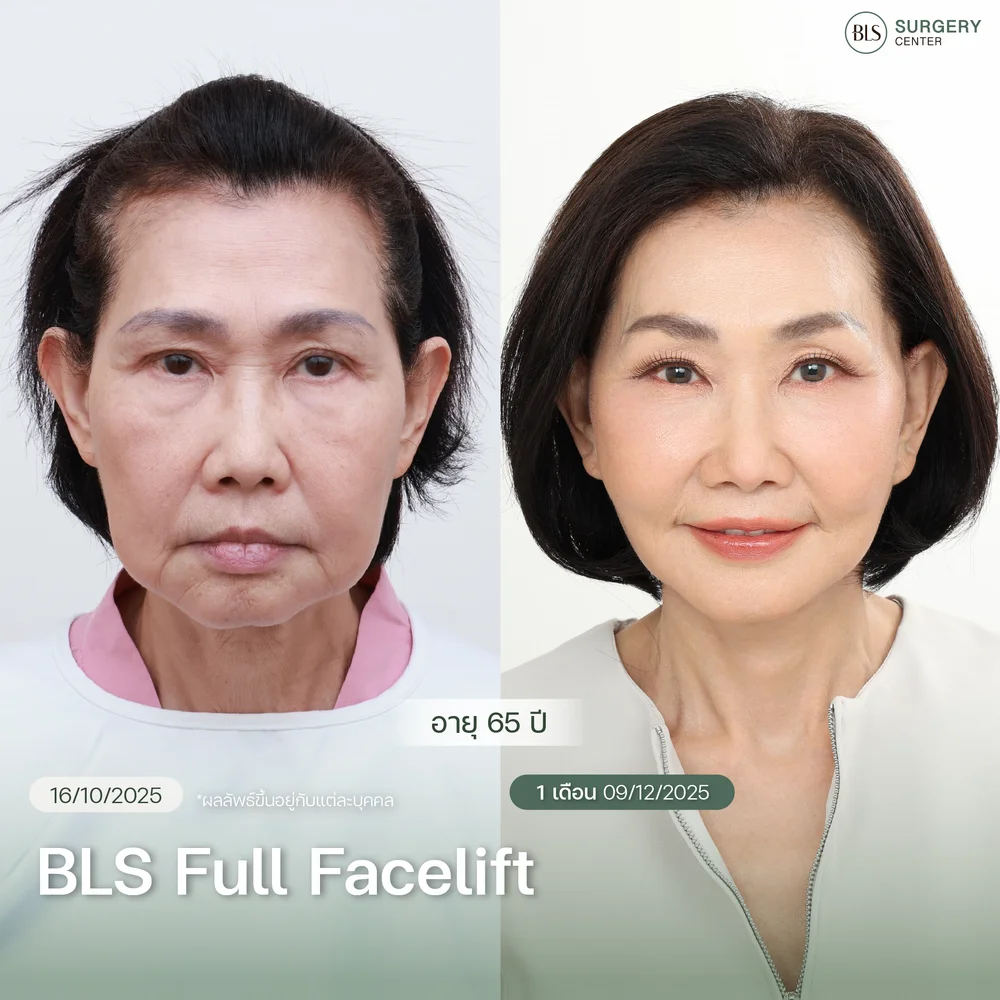 รีวิวเคสทำ BLS Full Facelift ที่ให้ผลลัพธ์เป็นธรรมชาติ