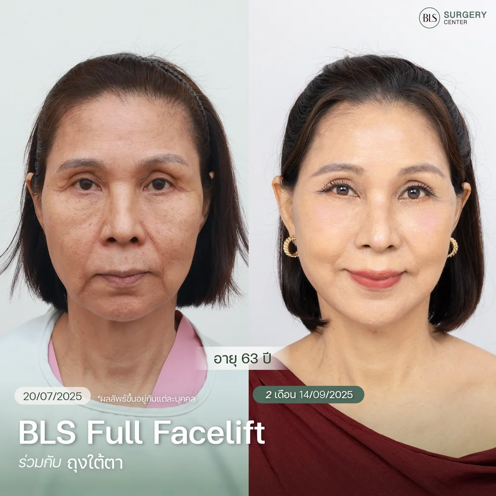 รีวิวเคสทำ BLS Full Facelift ที่ให้ผลลัพธ์เป็นธรรมชาติ