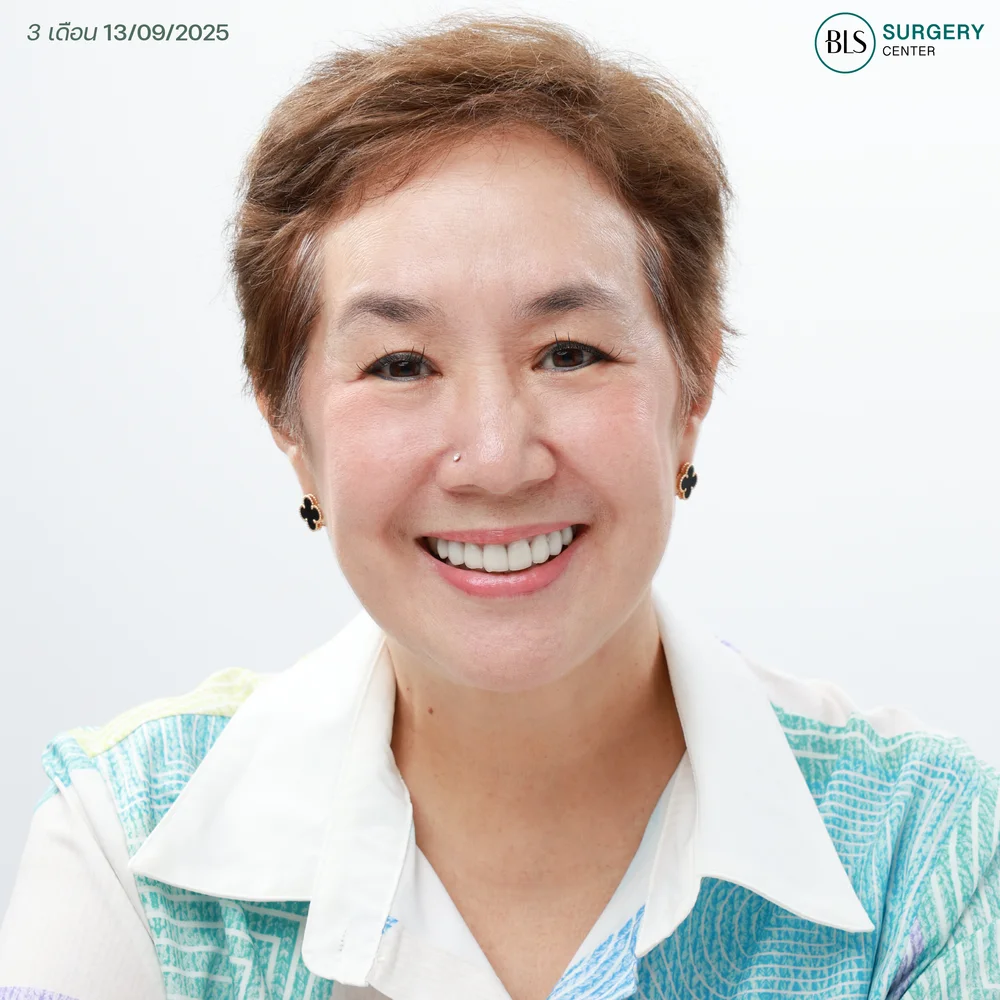 รีวิวดึงหน้าแม่เขื่อน ภัทรดนัย สวยสดใสในวัย 60 ปี