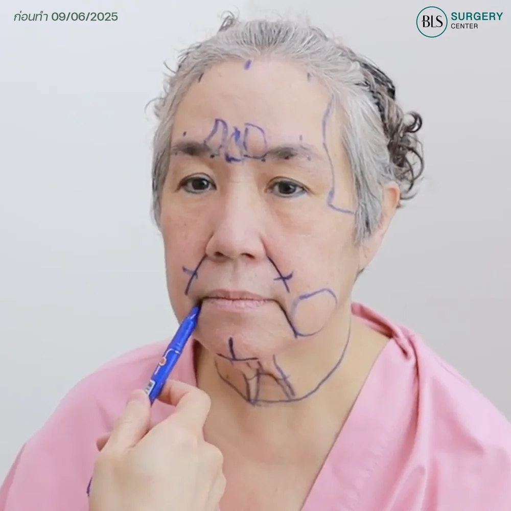 แชร์ประสบการณ์ ดึงหน้าแม่ตั้ม (แม่เขื่อน ดนัย)