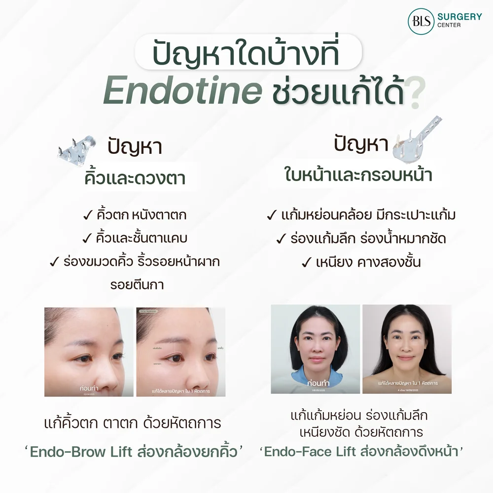 เอนโดไทน์อยู่ได้นานแค่ไหน ช่วยอะไรได้บ้าง ?