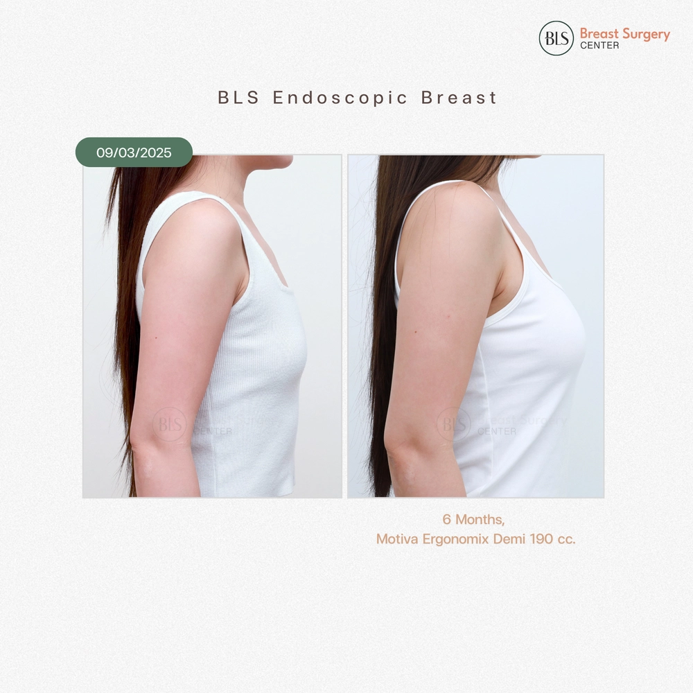ปัญหาก่อนทำ เนื้อหน้าอกน้อย ดูอกแบน แต่งตัวยาก หลังเสริมหน้าอก ซิลิโคน Motiva Ergonomix Demi 190 cc ช่วยให้มีเนินอกสวยๆ ทรงคุณหนู ดูละมุนและเป็นธรรมชาติ