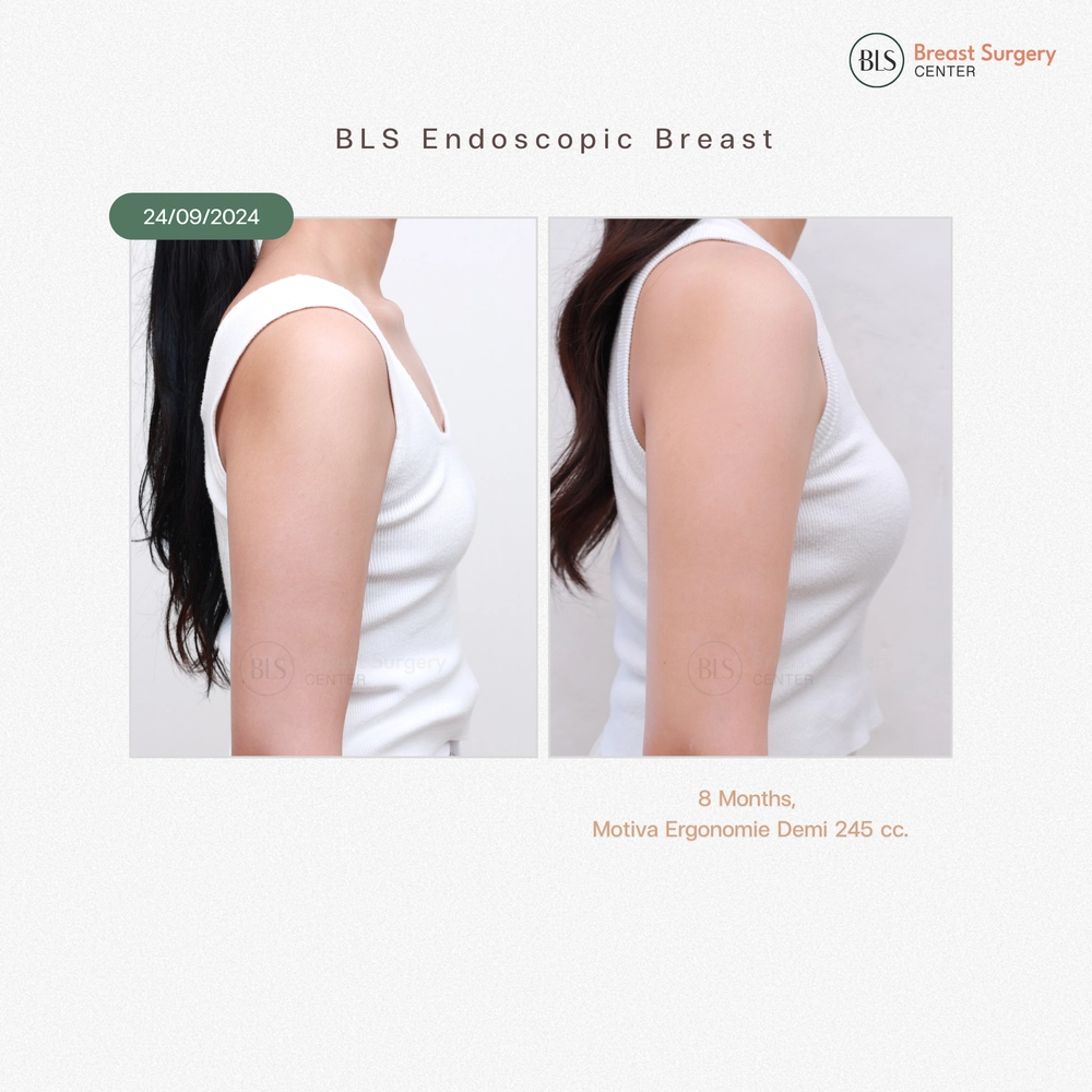 ปัญหาก่อนทำ รูปร่างเล็ก ทำให้หน้าอกเล็กตามไปด้วย หลังเสริมหน้าอกซิลิโคน Motiva Ergonomix Demi 245 cc ทำให้รูปร่างสมส่วน ดูดีมากขึ้น ทรงหน้าอกสวยดูธรรมชาติ