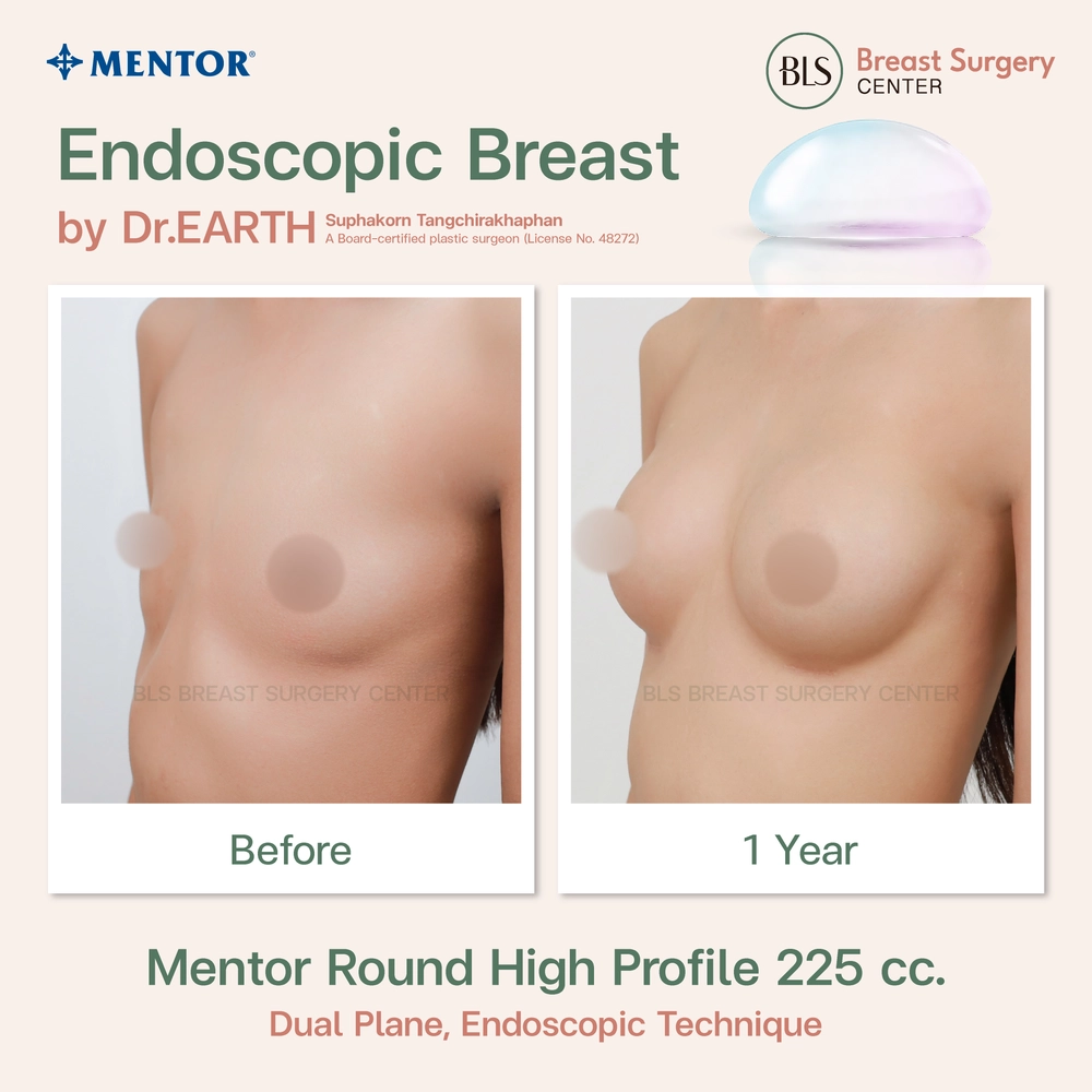 ปัญหาก่อนทำ หน้าอกแบน รูปร่างดูไม่ได้สัดส่วน หลังเสริมหน้าอกซิลิโคน Mentor Round High Profile 225 cc ช่วยเพิ่มขนาดทรวงอก หน้าอกดูอิ่มเอิบ ลุคคุณหนู พร้อมรูปร่างที่ดูดี มีสัดส่วนที่ดีขึ้นอย่างเป็นธรรมชาติ