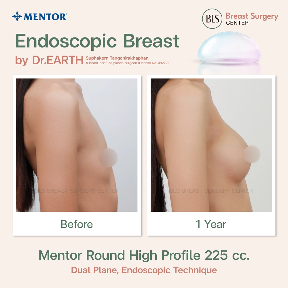 ปัญหาก่อนทำ หน้าอกเล็ก หลังเสริมหน้าอกซิลิโคน Mentor Round High Profile 225 cc ช่วยเพิ่มขนาดหน้าอก รูปร่างได้สัดส่วนมากขึ้น หน้าอกทรงสวย ผลลัพธ์เป็นธรรมชาติ