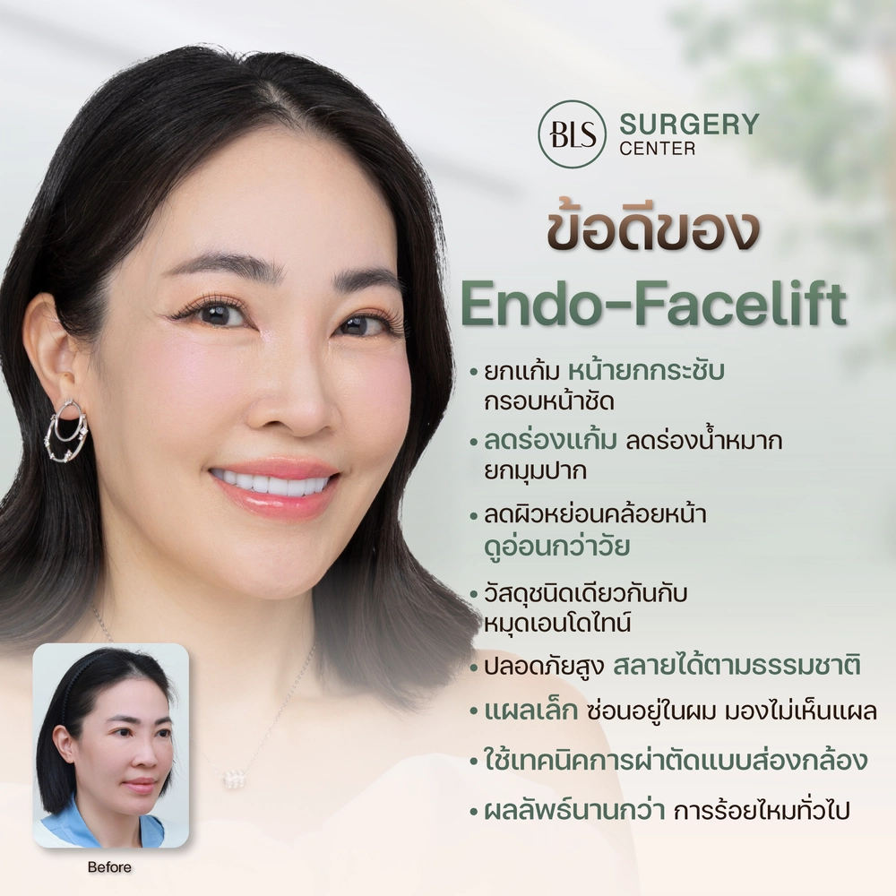 ข้อดีของ Endo-Face Lift