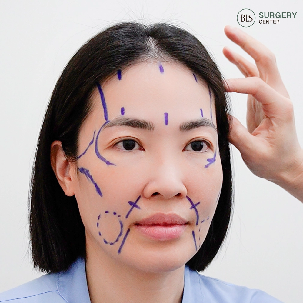 ขั้นตอนการทำ Endo-Face Lift ออกแบบการยกกระชับ และลด ร่องแก้มลึก