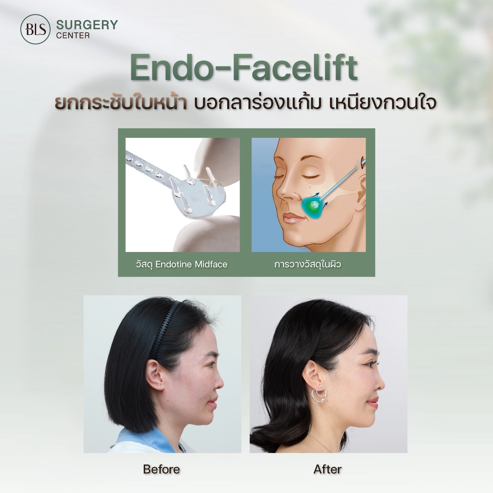ขั้นตอนการทำ Endo-Face Lift ส่องกล้องดึงหน้า