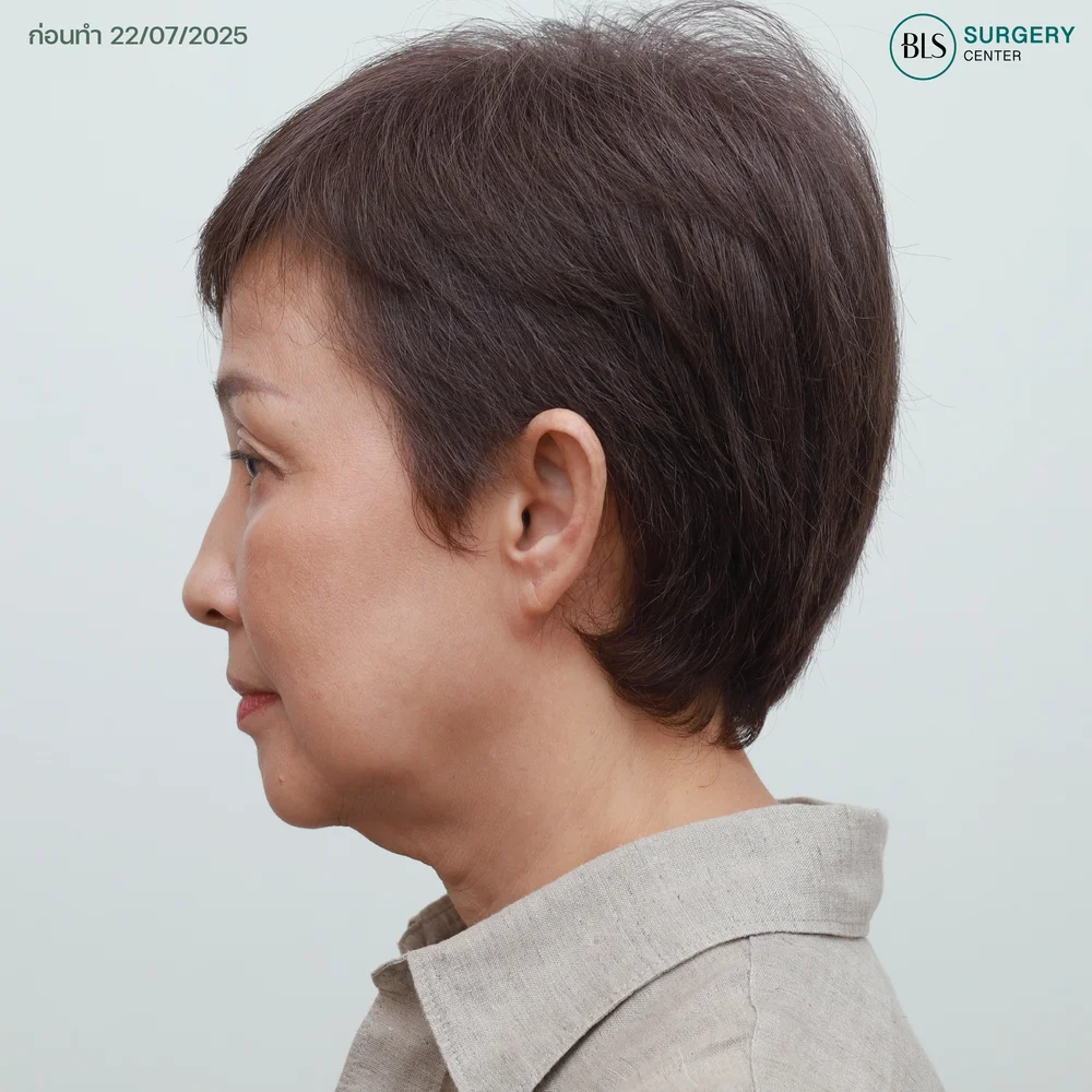 อายุเท่าไหร่ควรดึงหน้า