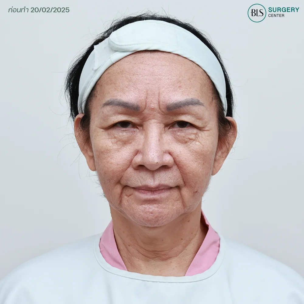 BLS Surgery Center ดึงหน้า ราคา