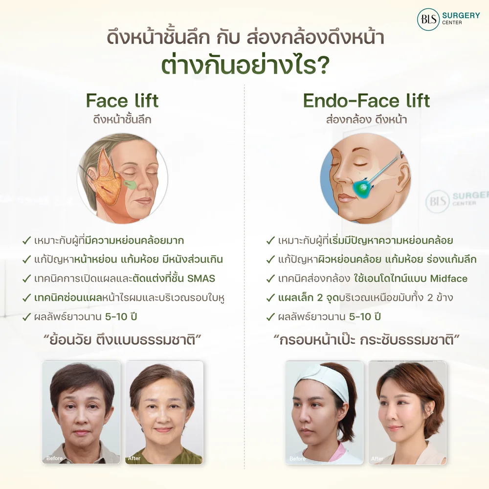 Facial lifting surgery for sagging skin and deep smile lines