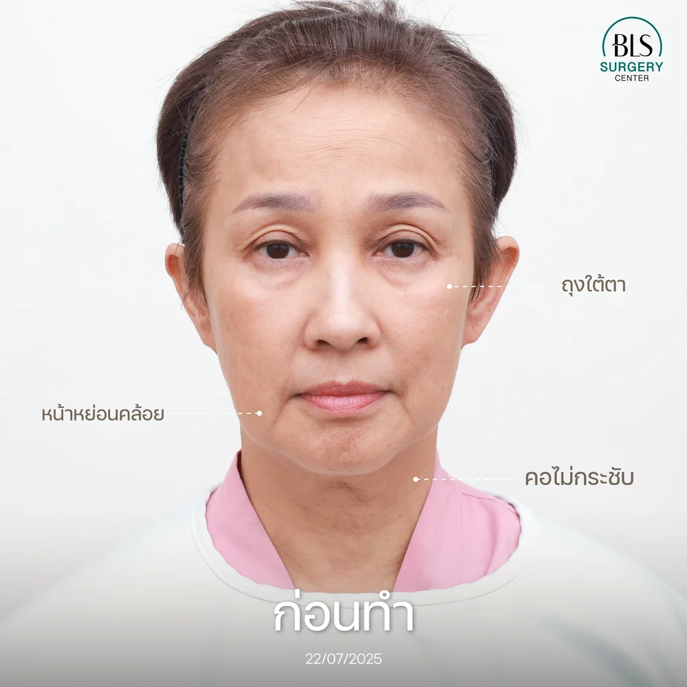 ดึงหน้าอยู่ได้กี่ปี ?