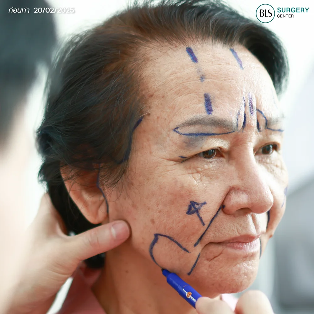 ดึงหน้าอยู่ได้กี่ปี ?