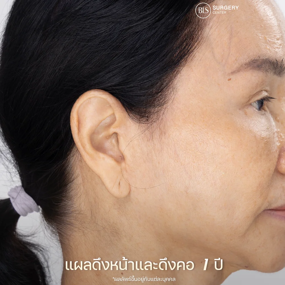 Facelift Results : Real Patient Reviews in Thailand