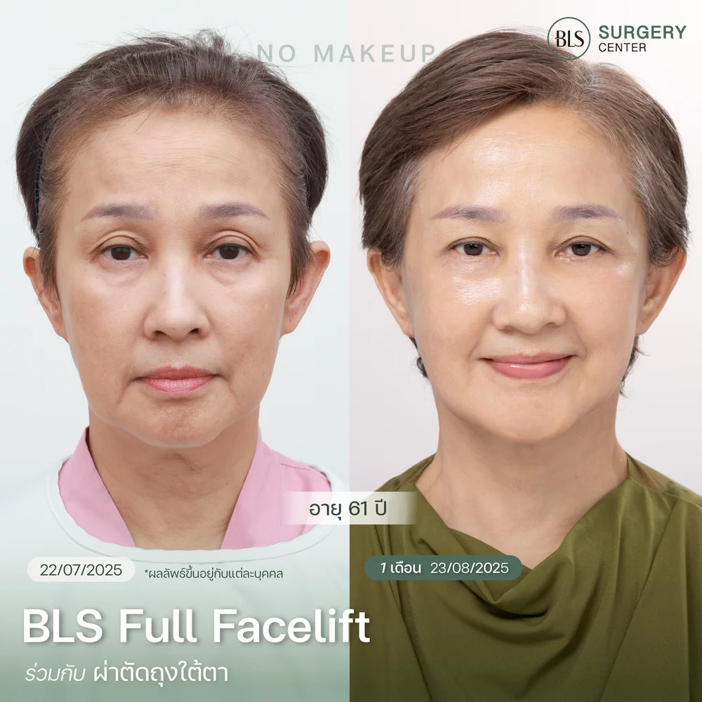 รีวิวผลลัพธ์หลังดึงหน้าจากลูกค้าจริง