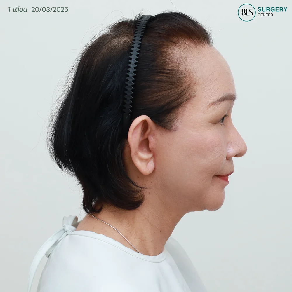 รีวิวดึงหน้า ที่ไหนดี