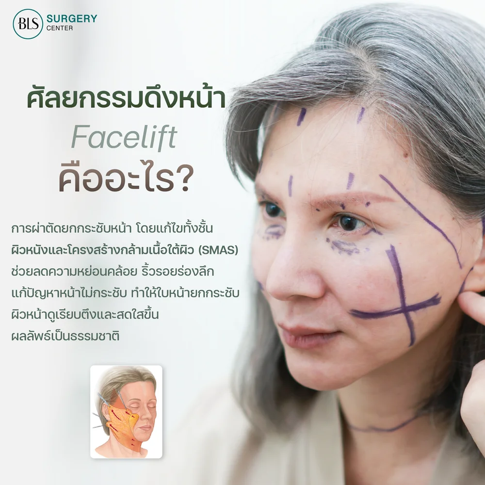 What Is a Facelift : Procedure and Process