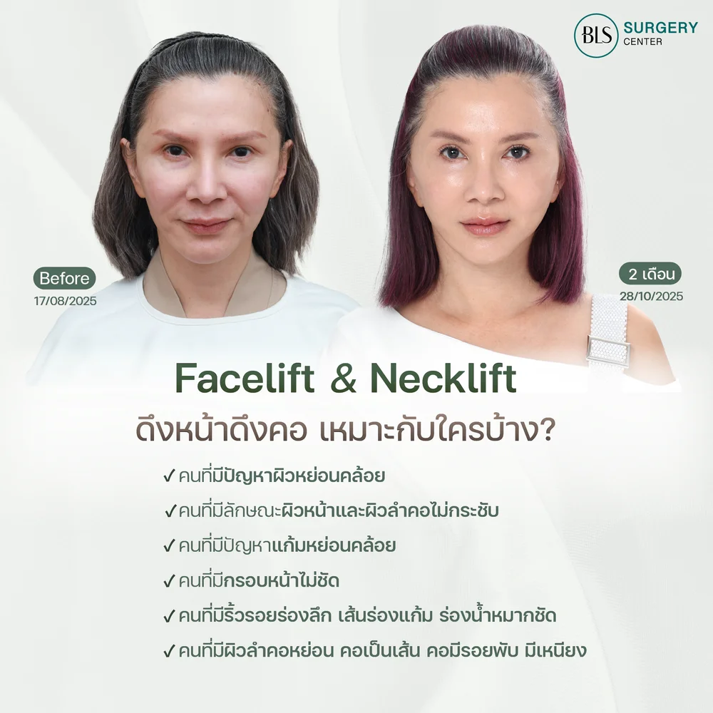 Facelift and Necklift Options for Patients Aged 40+