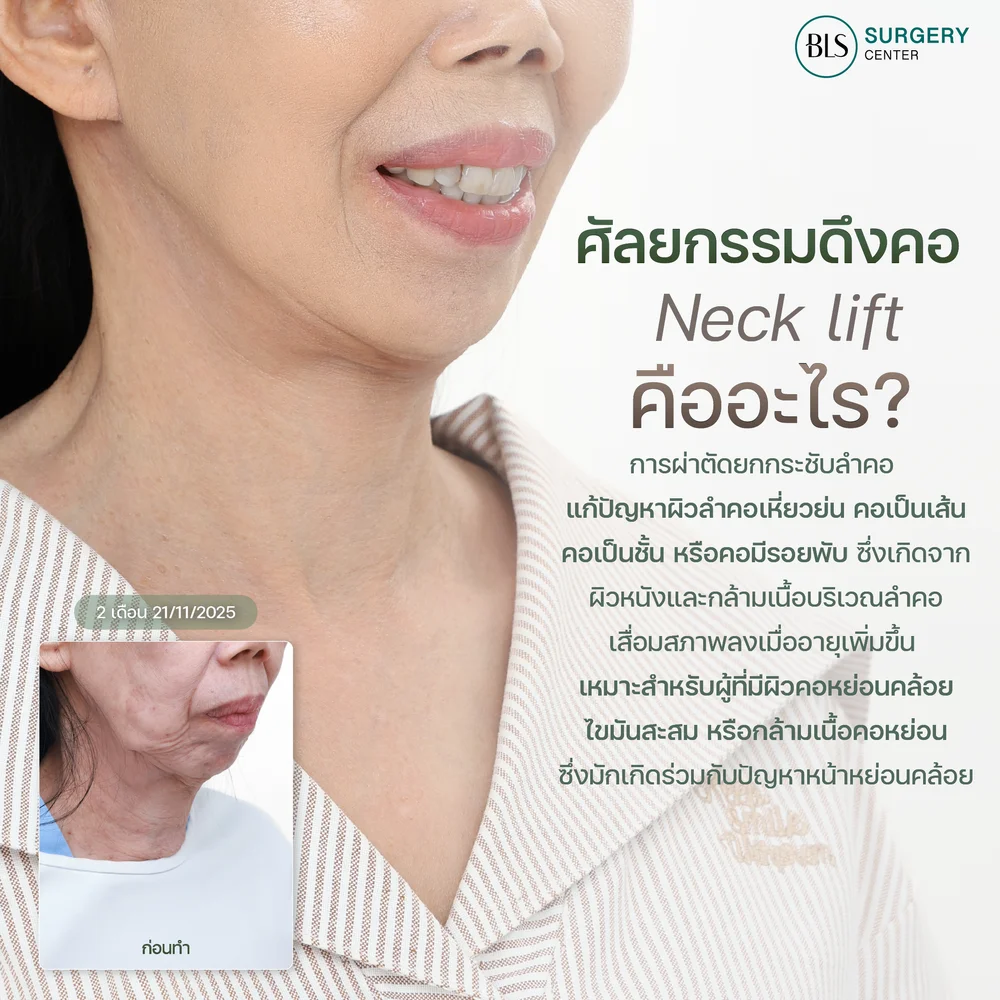 Which Neck Lifting Options Are Suitable for People Aged 40 and Above?