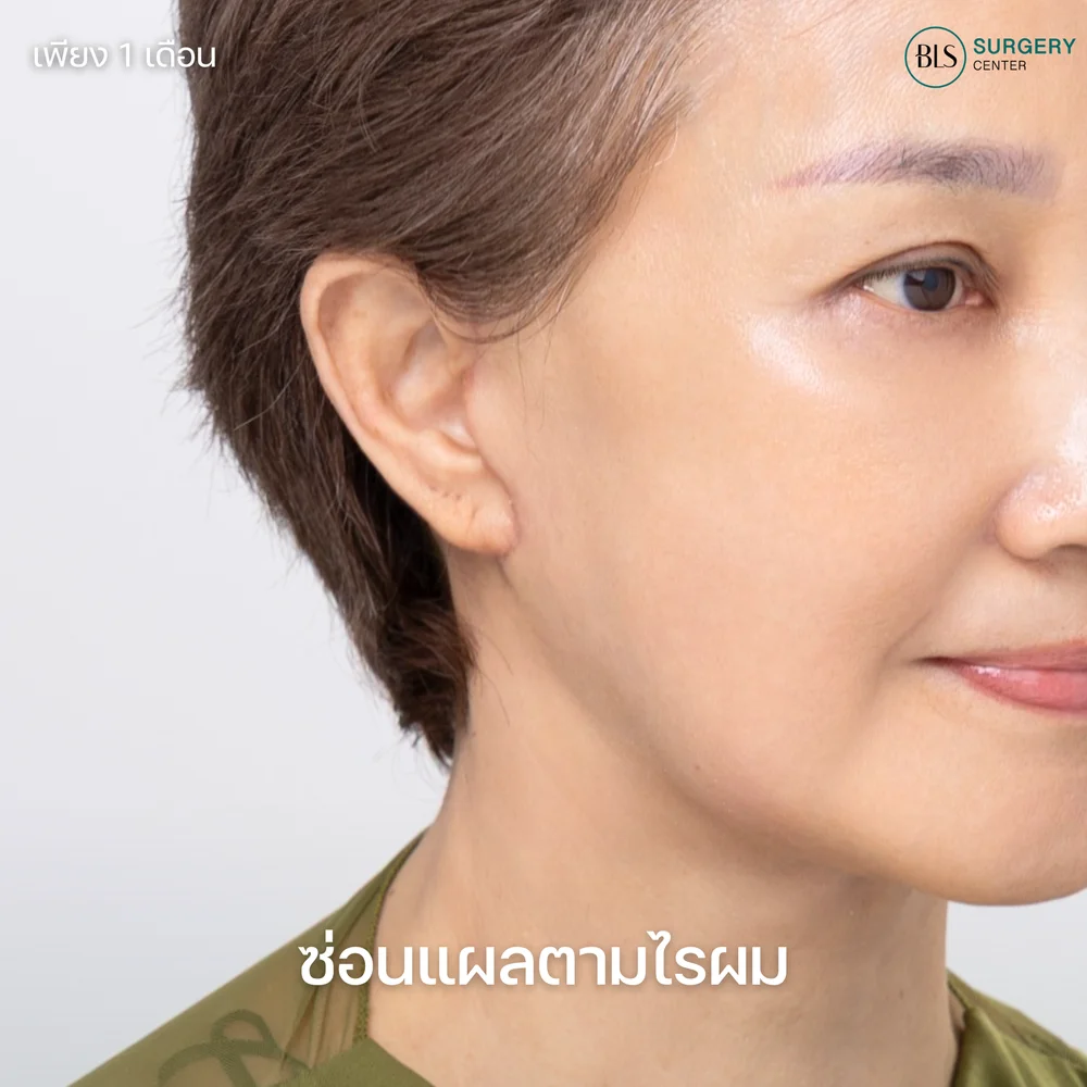 ผ่าตัดดึงหน้าที่ไหนดีสำหรับคนอายุ 40 ปีขึ้นไป แผลเนียน