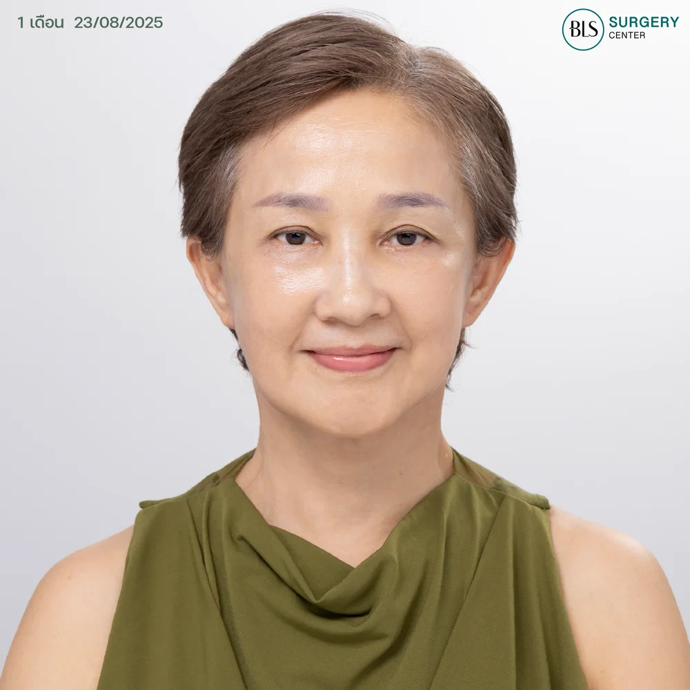 ดึงหน้า (facial lift) ผลลัพธ์ยาวนาน