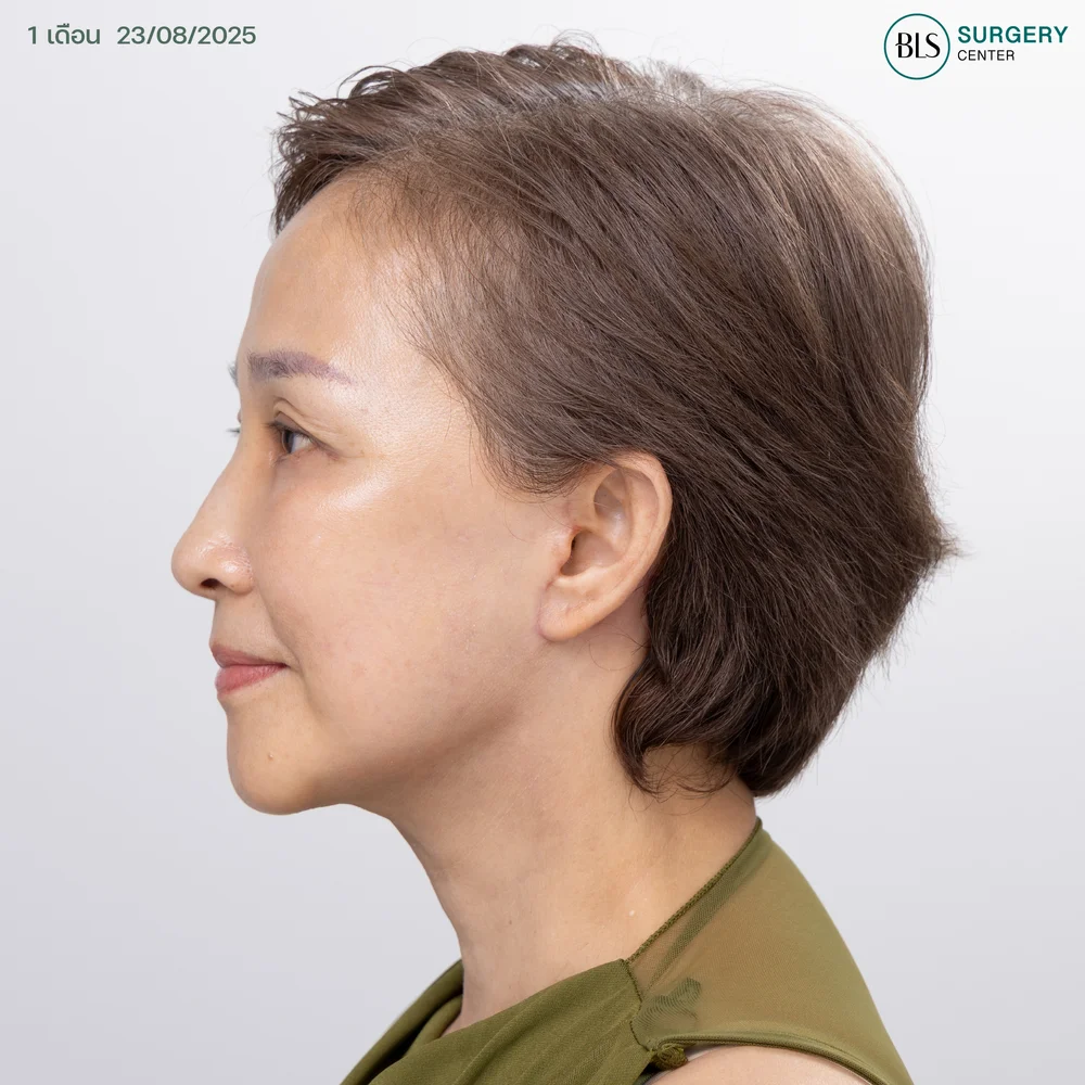 ดึงหน้า (facial lift) ผลลัพธ์ยาวนาน