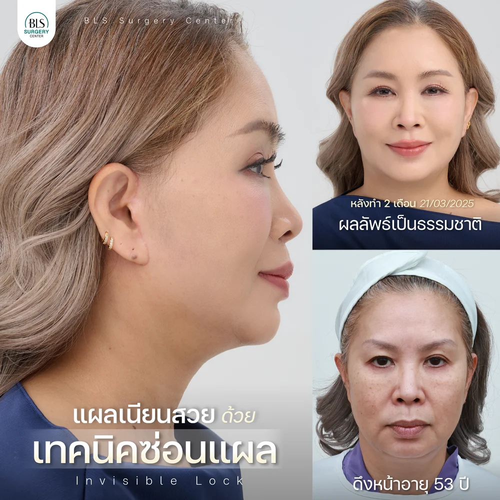 แก้ไขหน้าหย่อนคล้อย คอหย่อน ที่ BLS Surgery Center