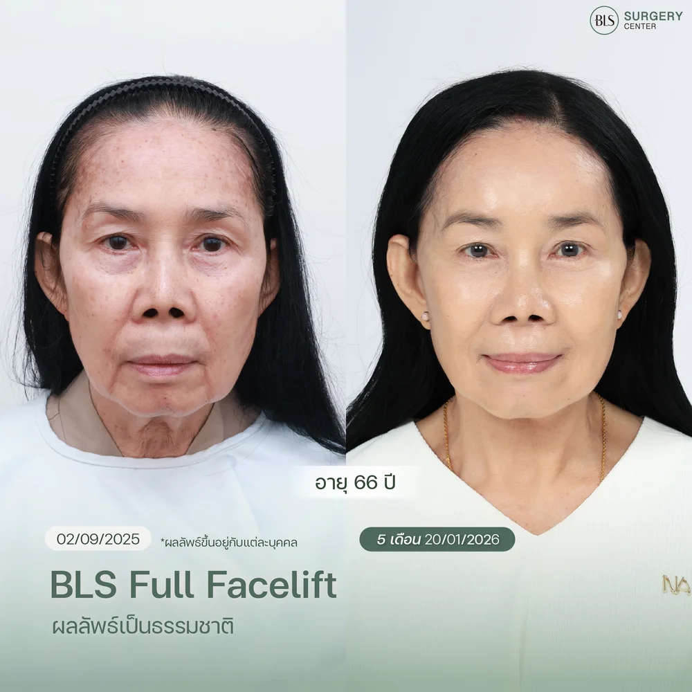 คลินิกดึงหน้าชั้นลึกในกรุงเทพที่ได้รับรีวิวดี