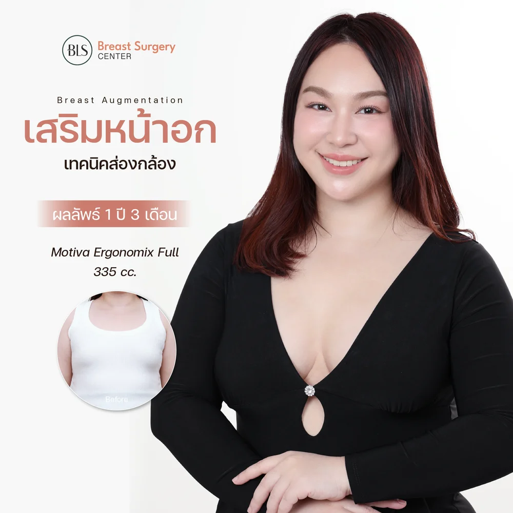 เสริมหน้าอกส่องกล้องกับซิลิโคนแบบไหนดีที่สุด