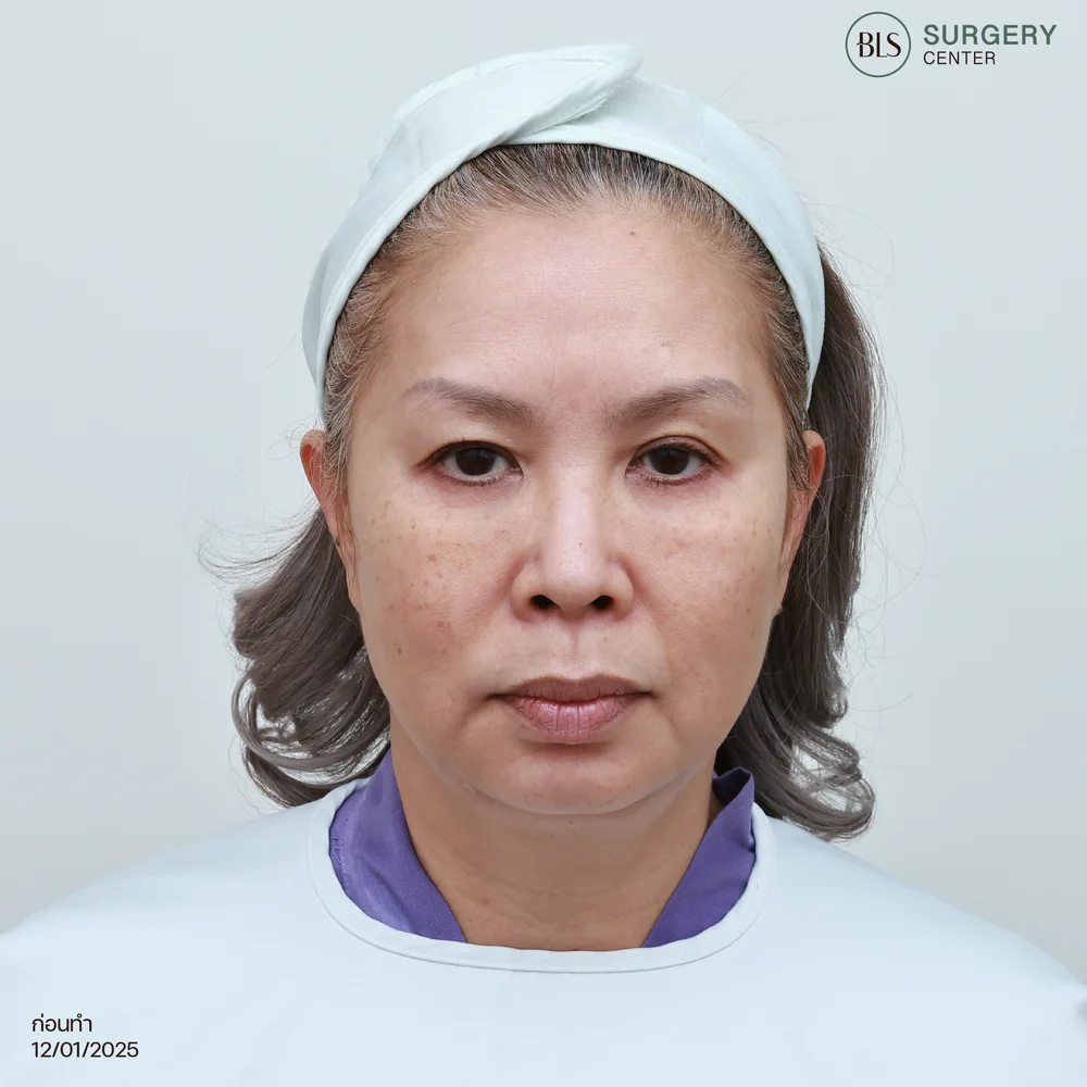 วิธีเตรียมตัวก่อนเข้ารับบริการดึงหน้าชั้นลึก