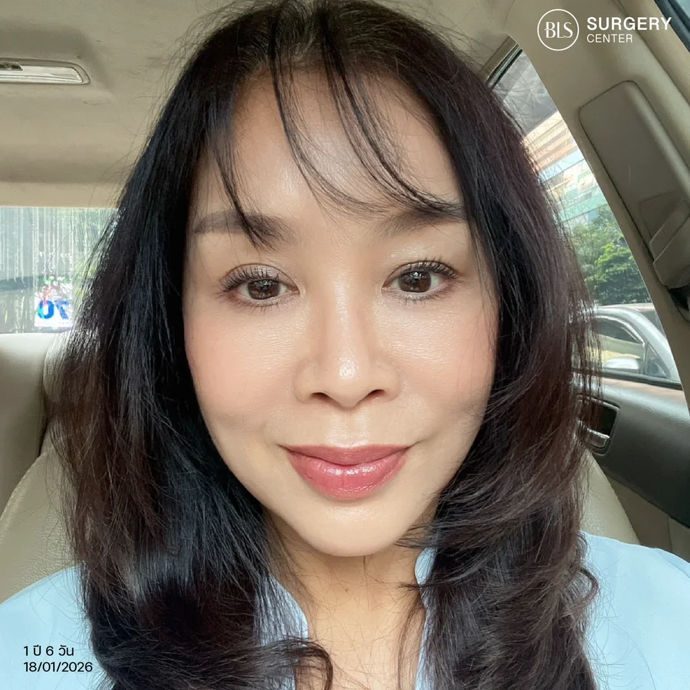 รีวิวผลลัพธ์หลังทำดึงหน้าชั้นลึกจากลูกค้าจริง