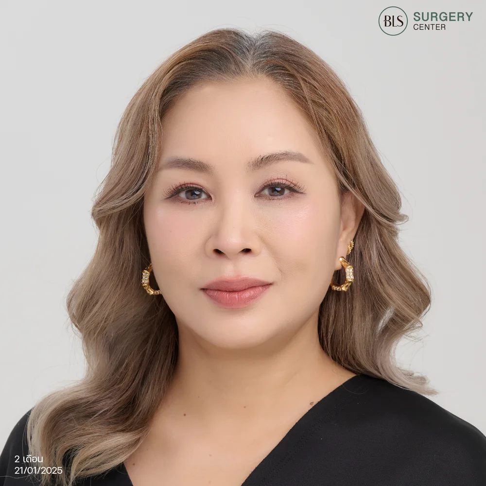 ผ่าตัดดึงหน้าที่ไหนดีสำหรับคนอายุ 40 ปีขึ้นไป (รีวิวคุณนีน่า สวยเป๊ะ)