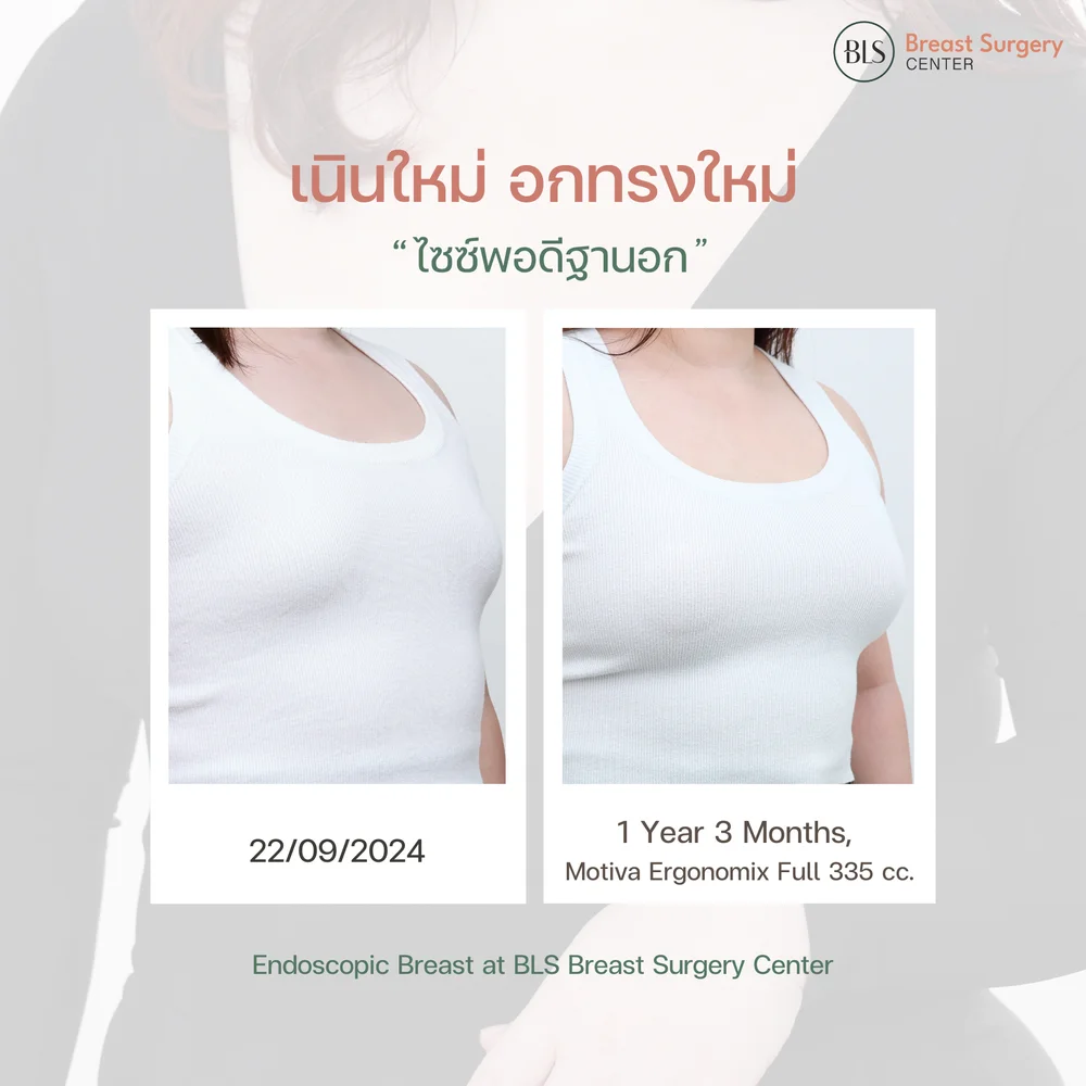 ข้อมูลการเสริมหน้าอกสำหรับคุณแม่หลังคลอด