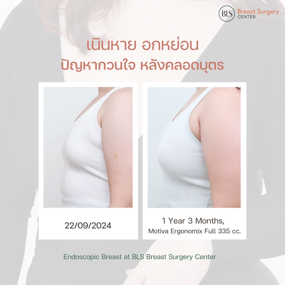 เสริมหน้าอกแล้วให้นมลูกได้ไหม