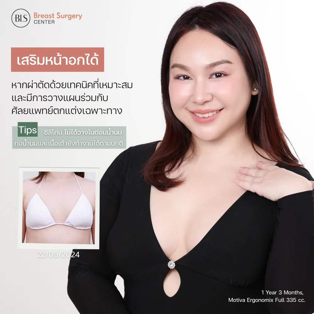 หลังเสริมหน้าอกพักฟื้นกี่วัน ให้นมลูกได้ไหม?