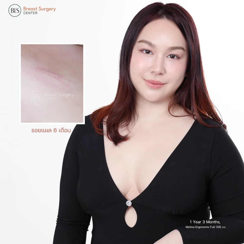 เสริมหน้าอกแล้วตั้งครรภ์ได้ไหม