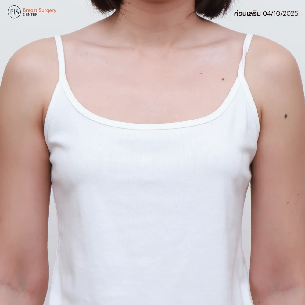 รีวิวประสบการณ์เสริมหน้าอกจากผู้ใช้จริง