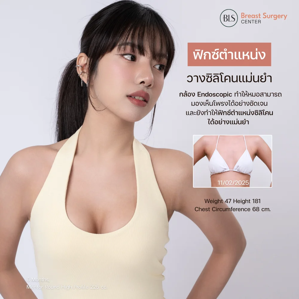 รีวิวคลินิกเสริมหน้าอกยอดนิยมในไทย