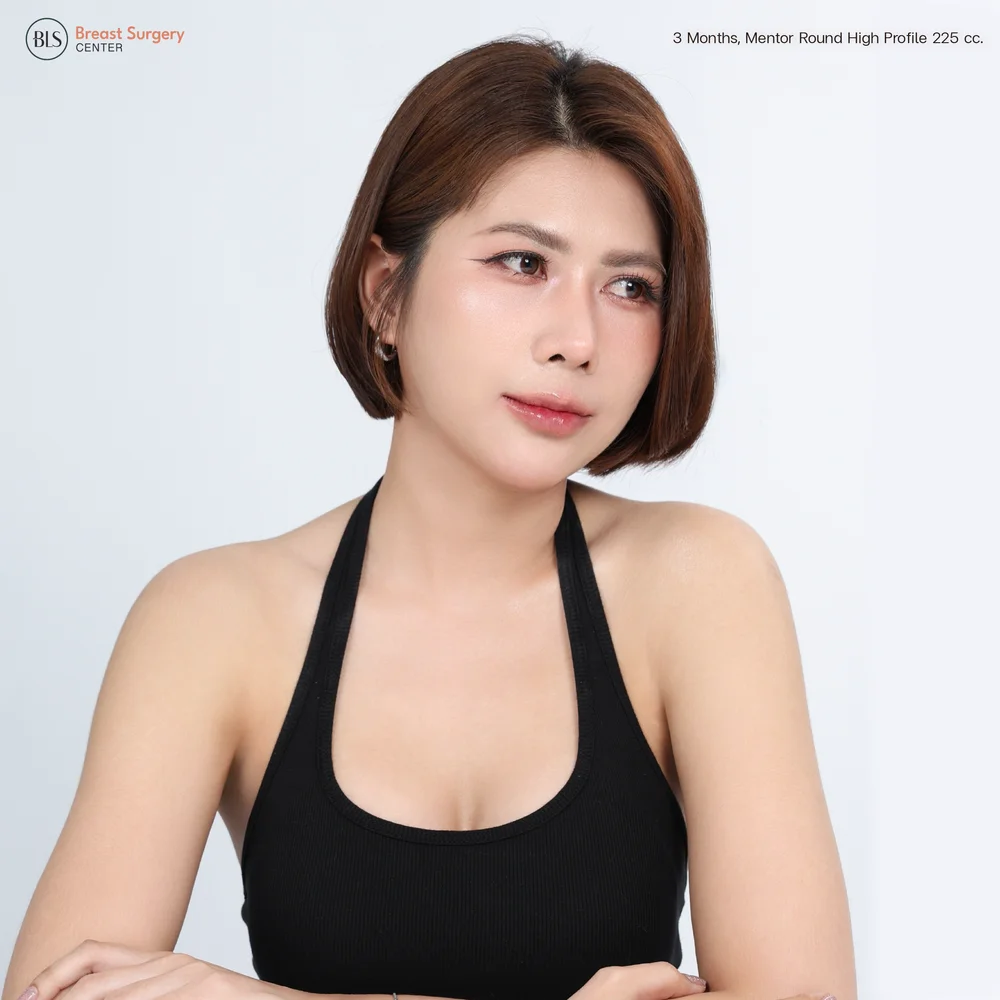 เสริมหน้าอกแบบไหนดีที่สุด