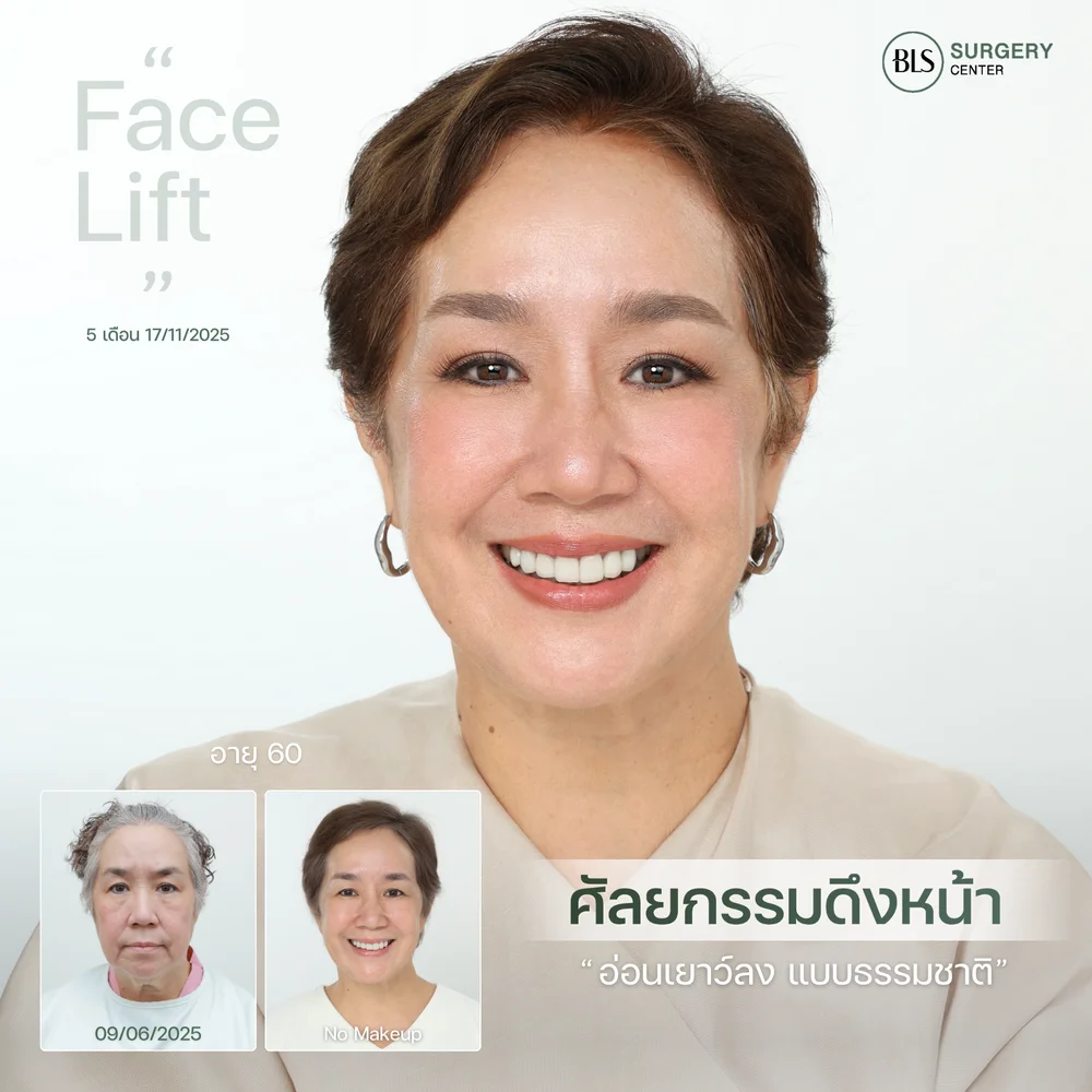 ดึงหน้าตอนอายุเท่าไหร่ดี