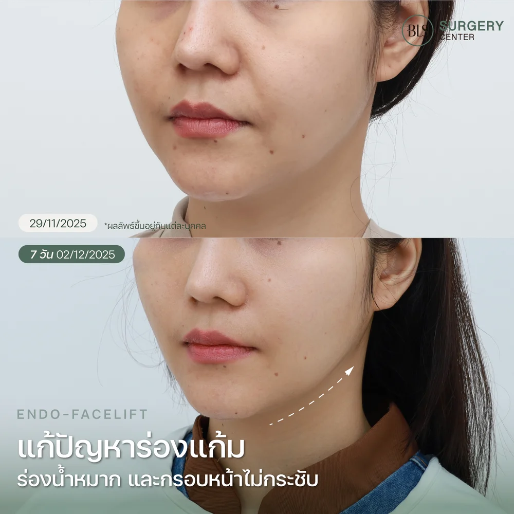 เทคนิคส่องกล้องดึงหน้า (Endo-Facelift)