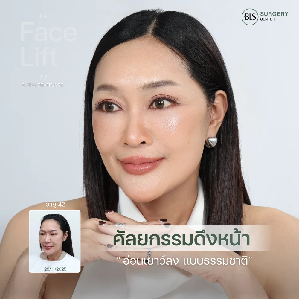 ดึงหน้าโดยศัลยแพทย์เฉพาะทาง