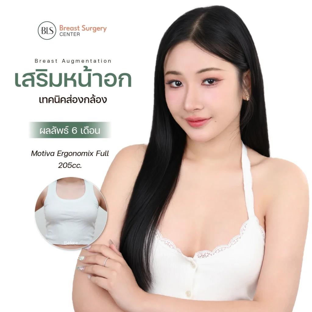 เสริมหน้าอกพักฟื้นกี่วัน ? กี่เดือนถึงเข้าที่ ?