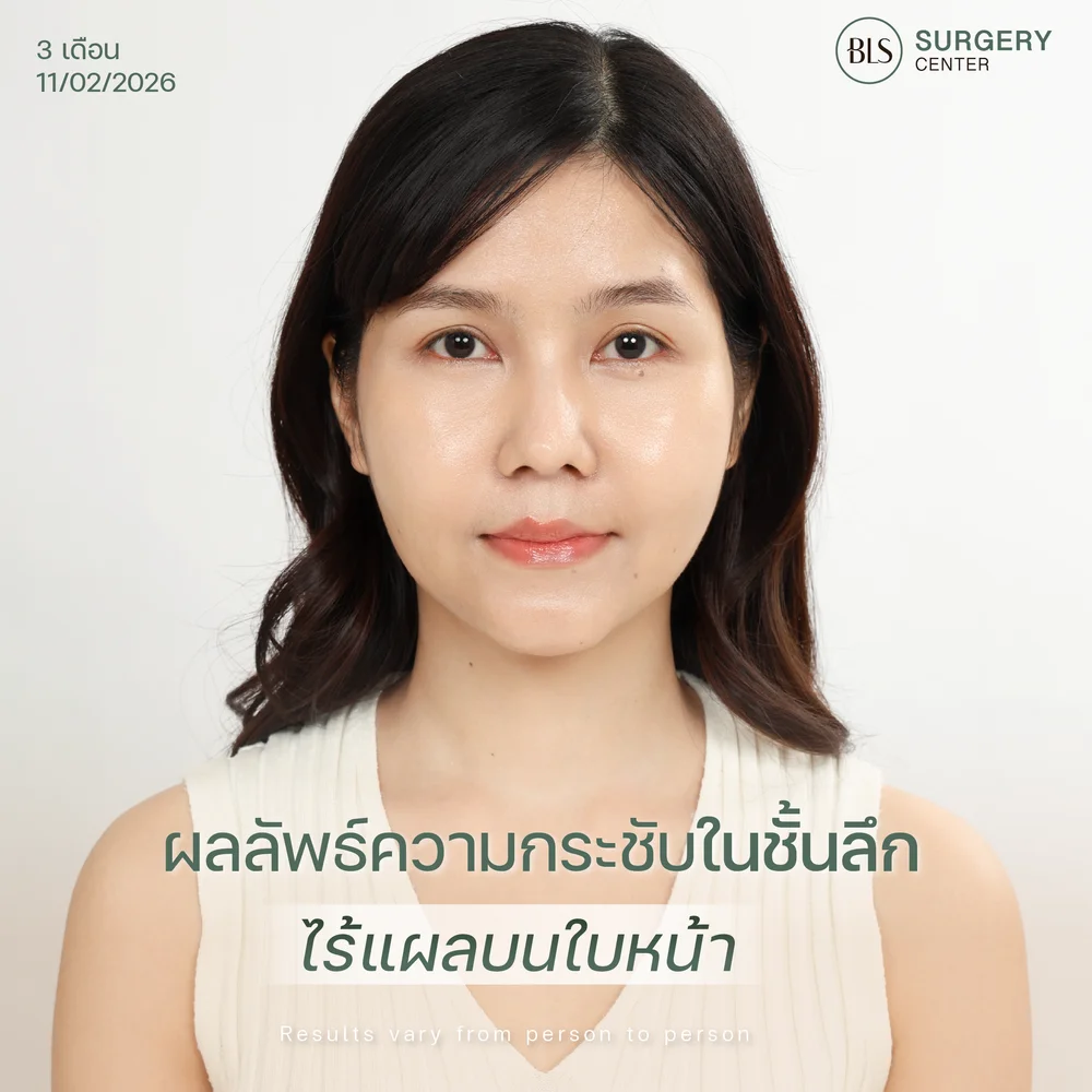 ดึงหน้าจำเป็นไหมในวัย 30
