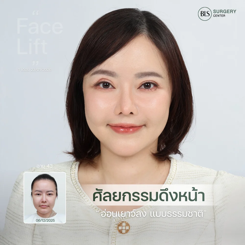 แก้มหย่อนก่อนวัย