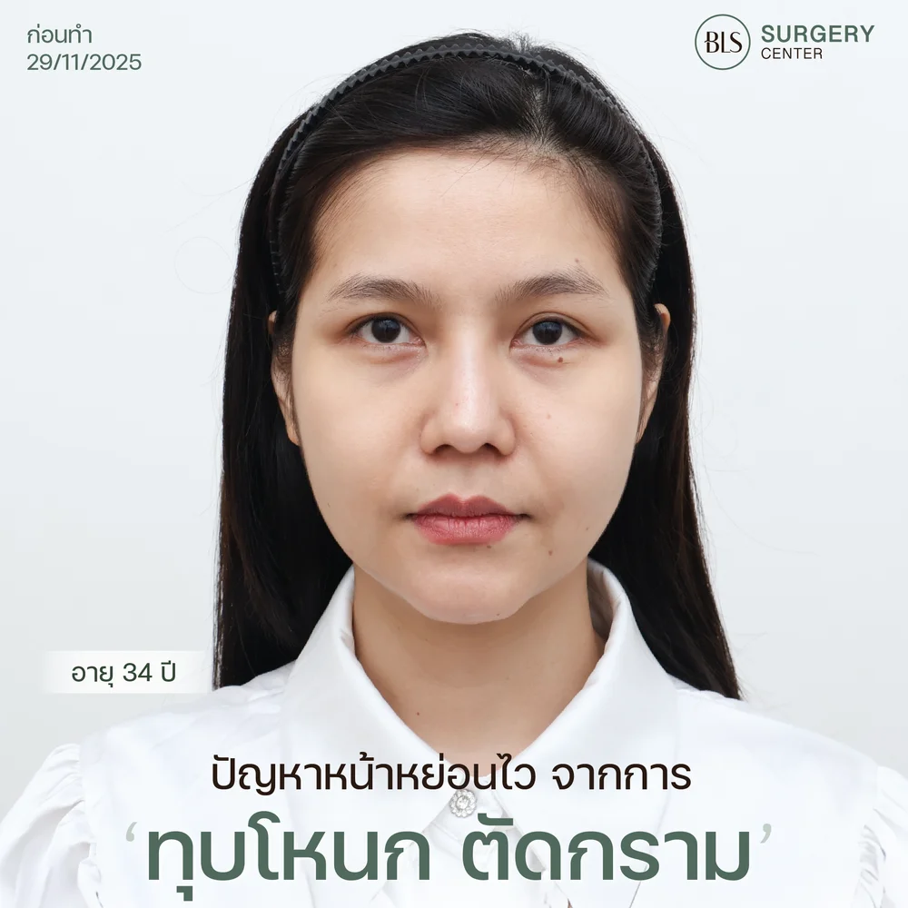 ผิวหย่อนคล้อยหลังทุบโหนกแก้ม